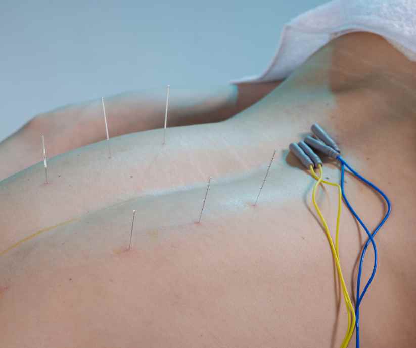 Electroacupuncture needles